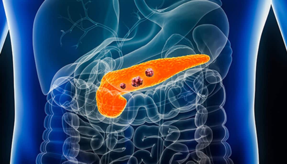 How to Spot Pancreatic Cancer in early Stages