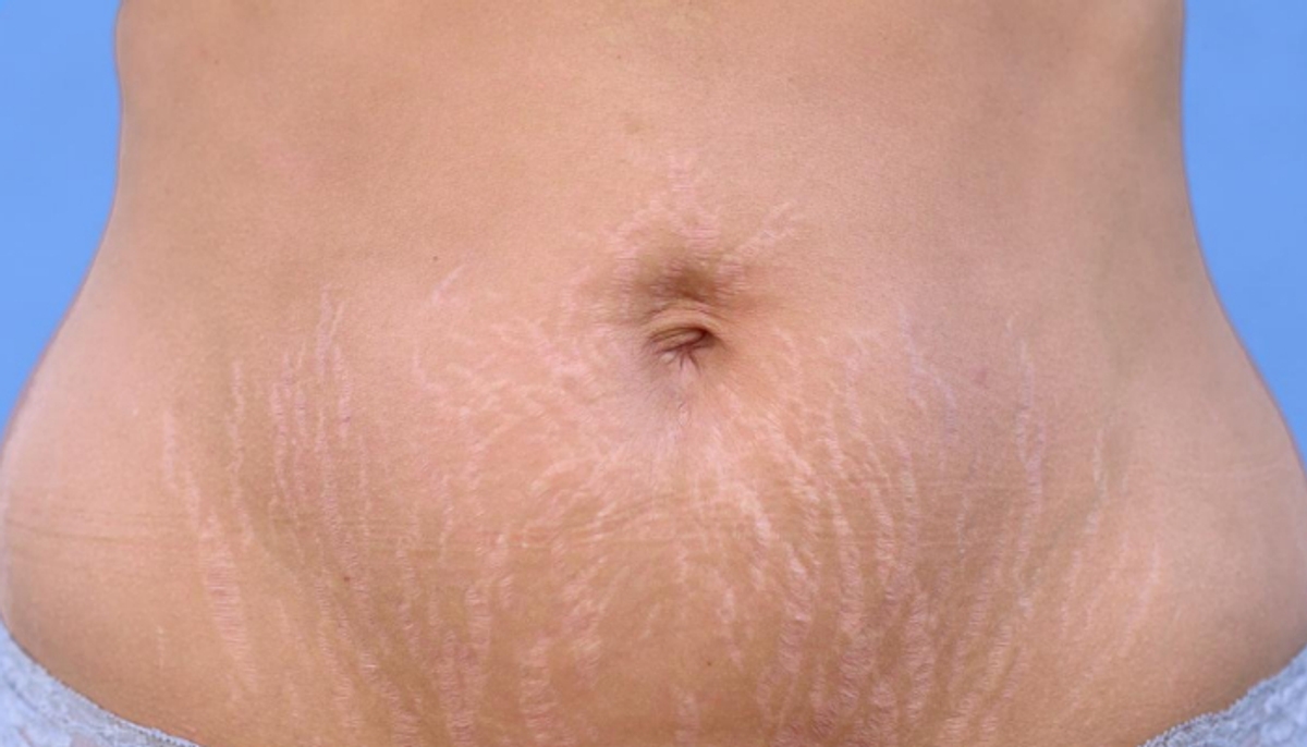 tips to get rid of stretch marks