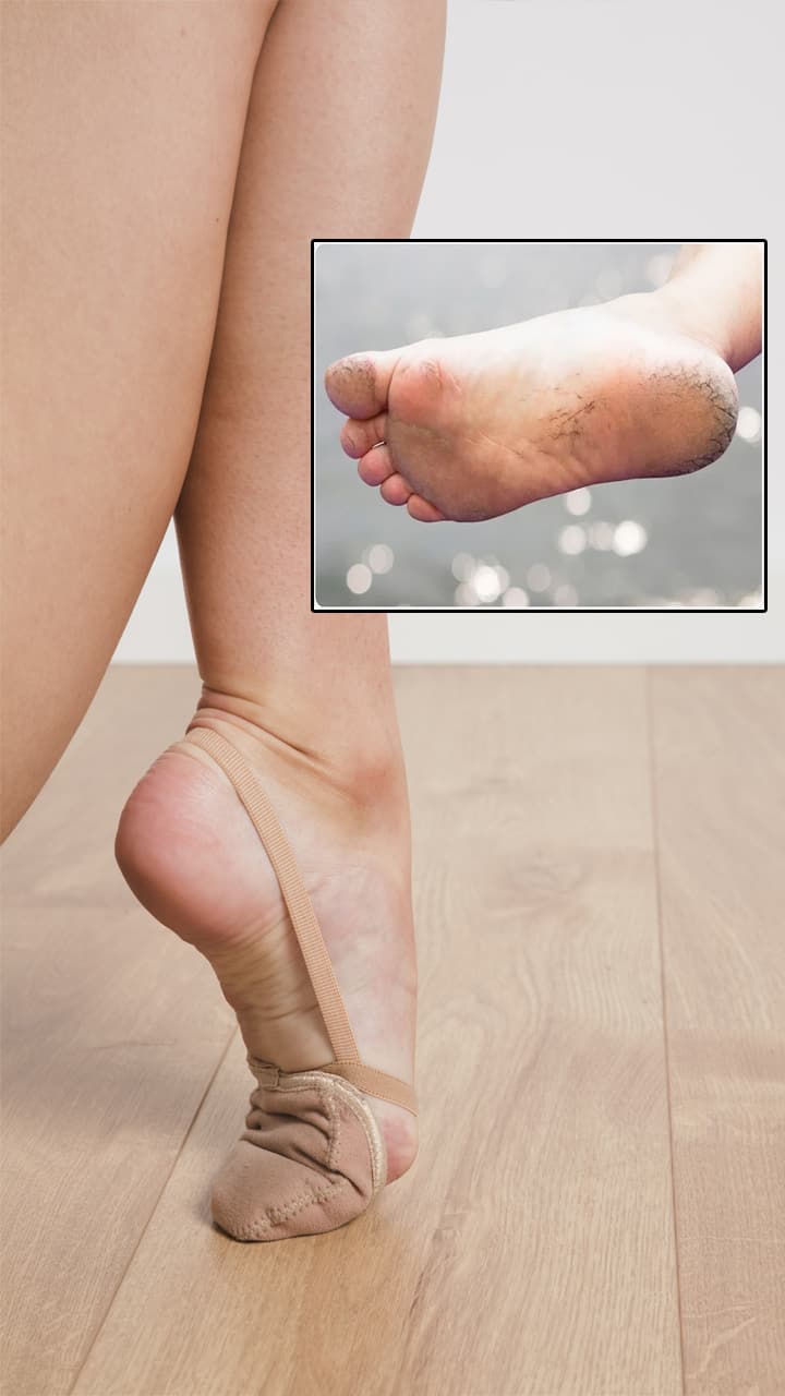  Top home remedies to heal and prevent cracked heels effectively NTI