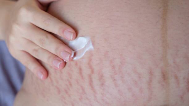  Stretch Marks