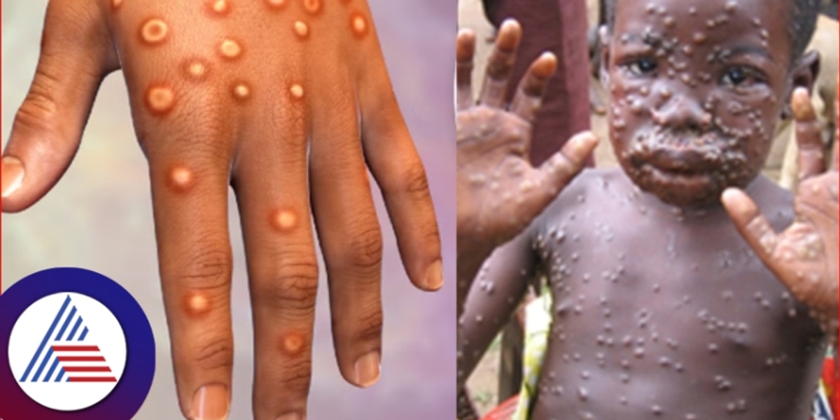 monkeypox entry to india what symptoms of disease rav