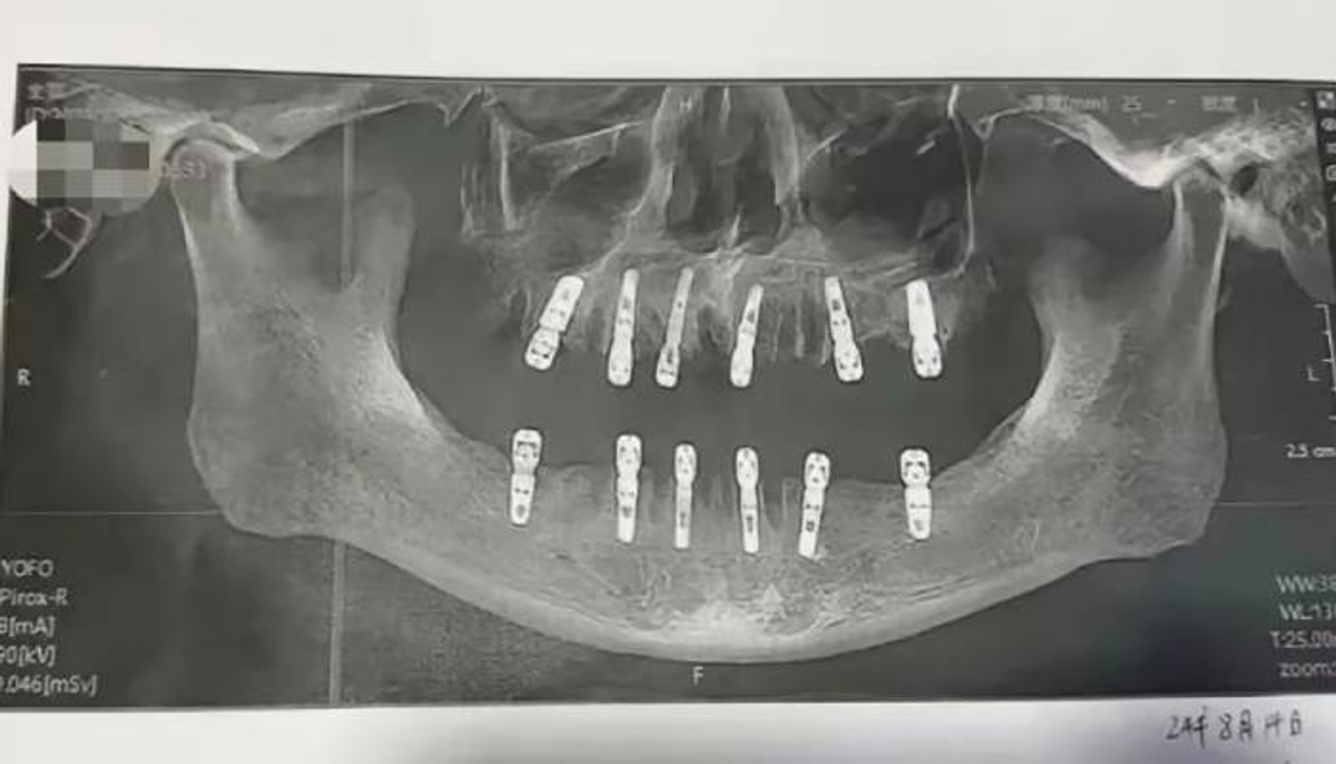 man died after 23 teeth extracted 12 implants placed in same day china 