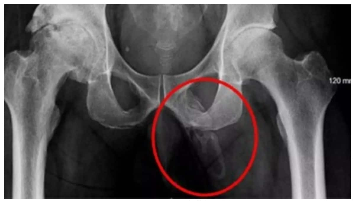 63 year old man who came for knee treatment was diagnosed with a rare disease in which the genitals turned into bone