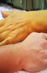 Home Remedies for Jaundice Treatment and Prevention