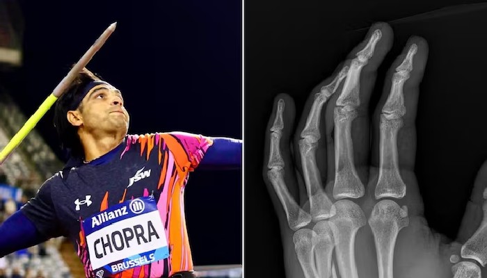 Javelin Thrower Neeraj Chopra reveals he competed in Diamond League Final with broken hand kvn