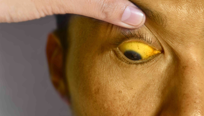 jaundice spread in kozhikode symptoms of jaundice