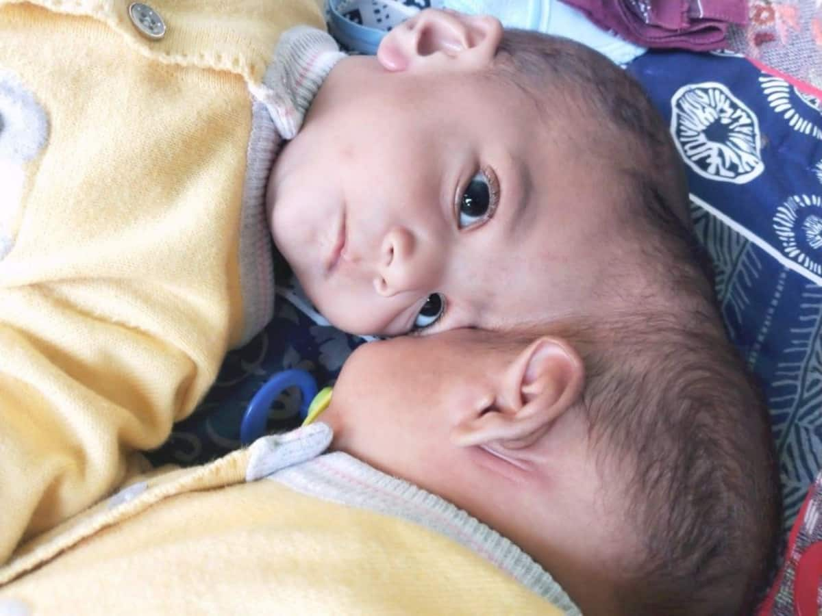 Pakistani conjoined twins separated after 14-hr operation, UK surgeon dubs  recovery as 'excellent' | SEE PICS