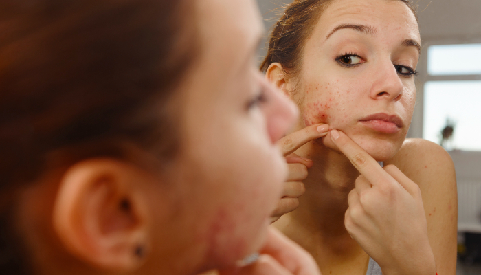 foods that cause acne chance 