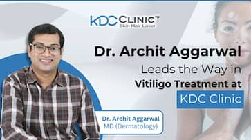 Dr. Archit Aggarwal Leads the Way in Vitiligo Treatment at KDC Clinic