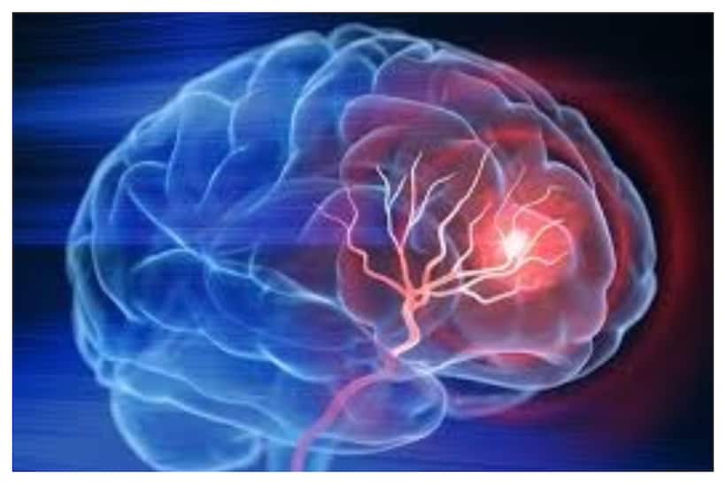 Rising Stroke Rates among Youth: A Call for Action by PM Modi's Campaign