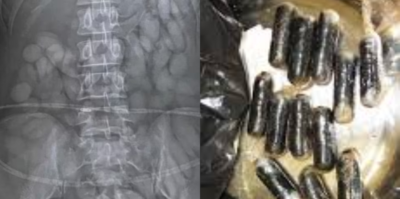 X ray reveals 60 cocaine bullets in young woman stomach 