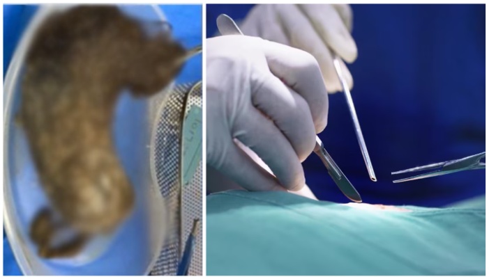 Hairball removed from 21 year old woman stomach roo