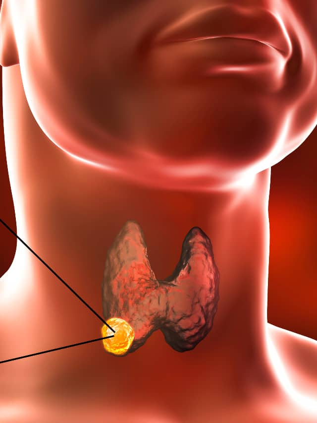 Symptoms of Thyroid Cancer