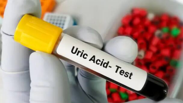 uric acid 