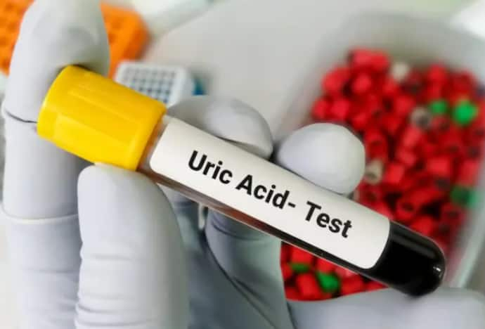 uric acid 