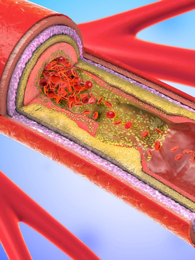 Easy ways of lowering cholesterol levels