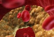 bad-cholesterol-symptoms-causes-normal-range