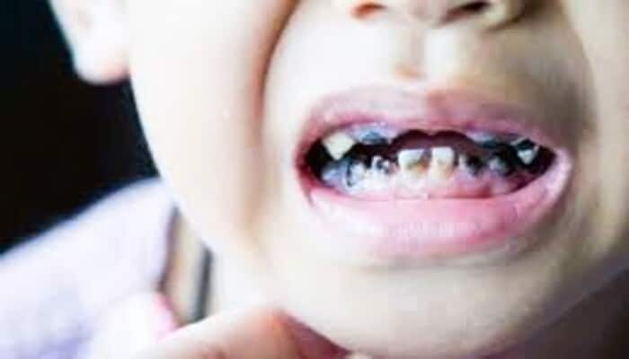 top foods that can harm your kids teeth in tamil mks