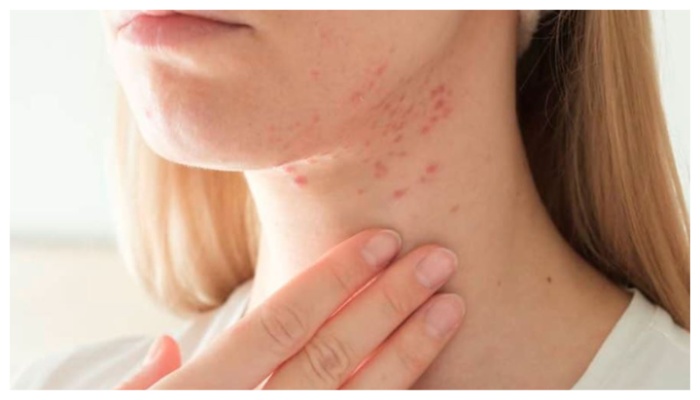 home remedies and reasons for neck acne