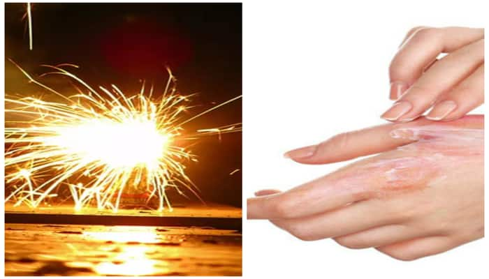 home remedies for treating firecracker skin burns during this diwali in tamil