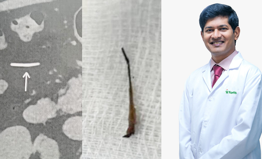 A Team of Fortis Hospital Doctors Removed a 2 cm long Fish Bone that had been in his Stomach for 5 years gvd