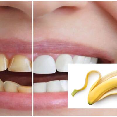 Do Banana Peels Really Whiten Teeth? Here’s What Science Says