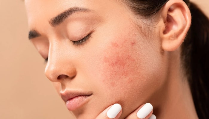 foods that worsen acne