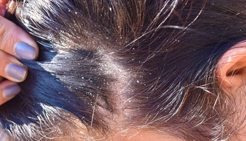 Get rid of dandruff: Home remedies for dandruff removal and itchy scalp