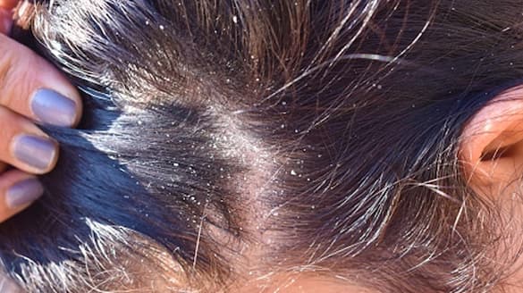 Home Remedies for Dandruff Removal and Itchy Scalp sat