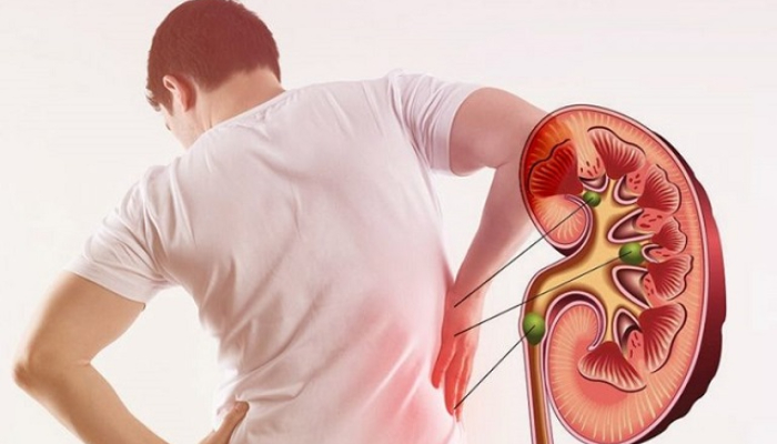 tips to prevent kidney stones