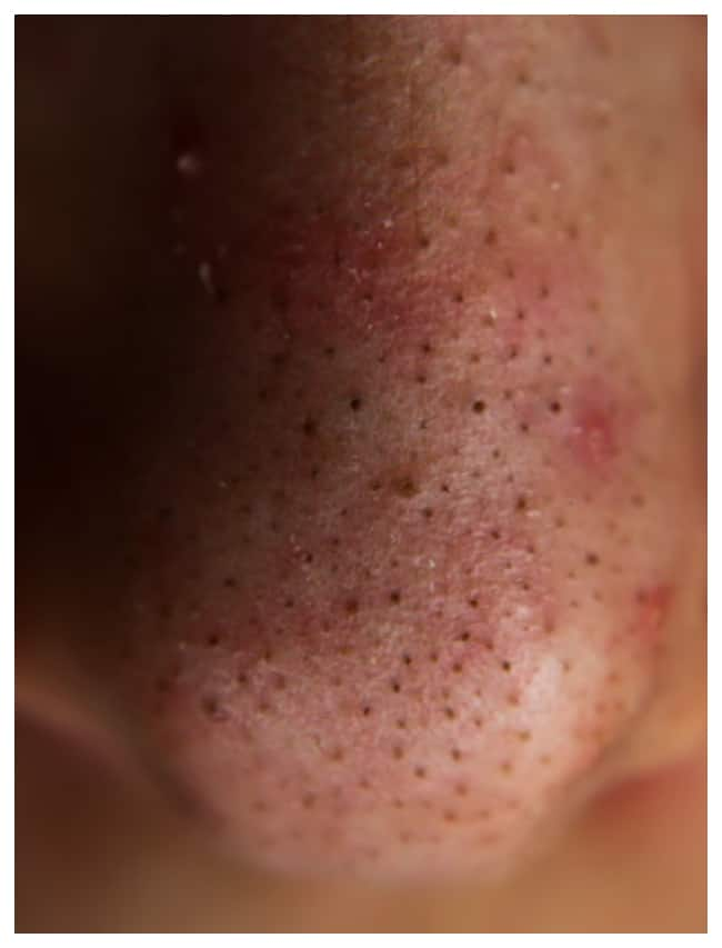 Easy Homemade Tips to Remove Blackheads rsl