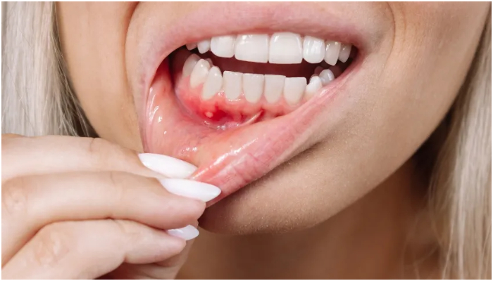 home remedies to cure mouth ulcers naturally