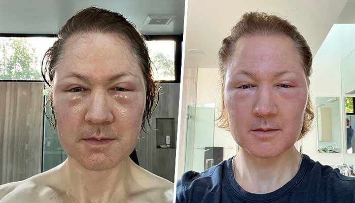 Biohacker Bryan Johnson's 'age-defying' treatment goes horribly wrong; shocking selfie shows extreme swelling snt