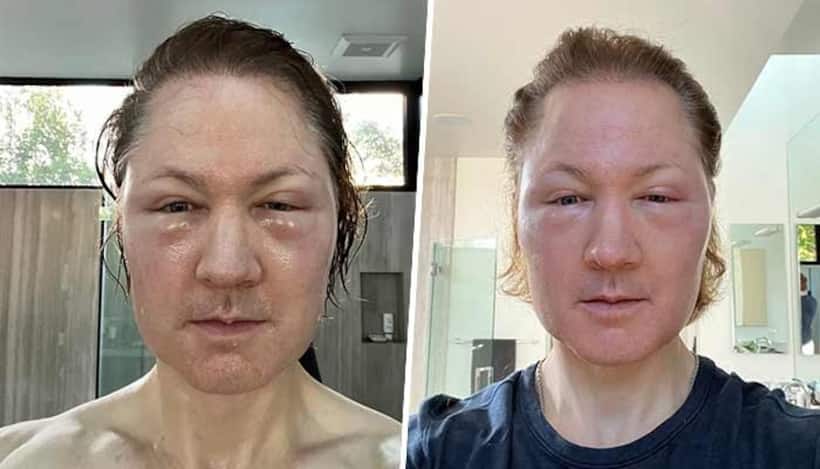 Biohacker Bryan Johnson's 'age defying' treatment goes horribly wrong; shocking selfie shows extreme swelling
