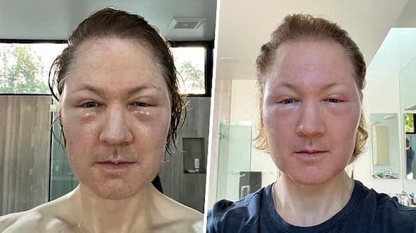 Biohacker Bryan Johnson's 'age-defying' treatment goes horribly wrong; shocking selfie shows extreme swelling snt