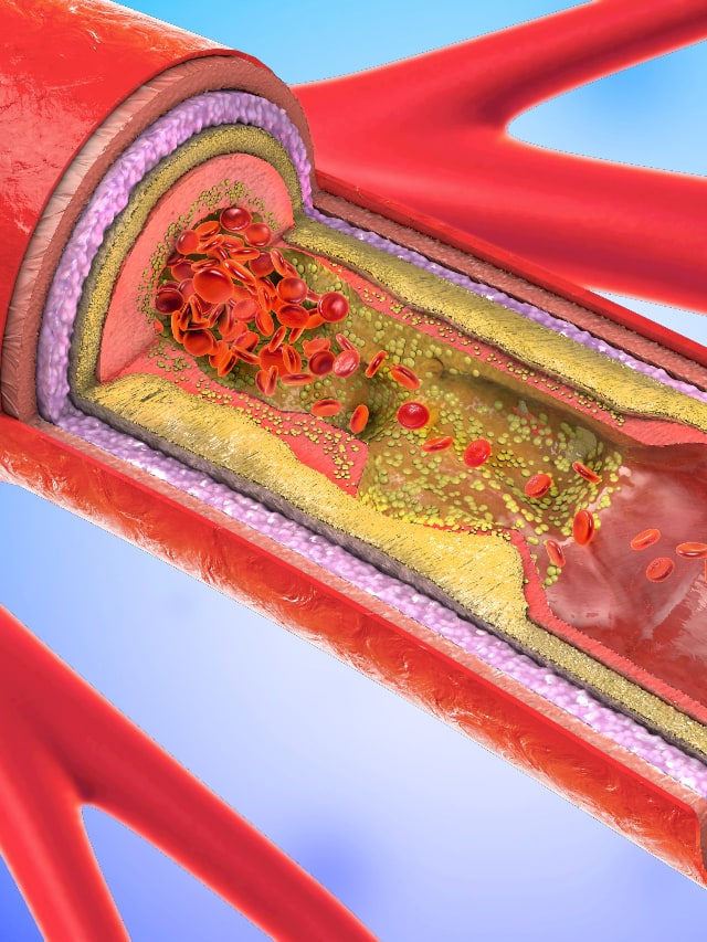 signs that secretly warn of high cholesterol 