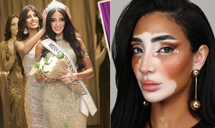 Logina salah create history first woman with vitiligo to compete Miss universe pageant ckm