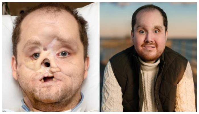 face of a US youth who was crushed in a suicide attempt has been successfully reconstructed after 10 years  