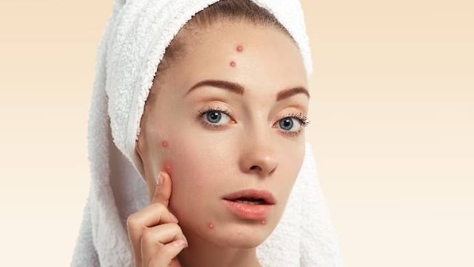 Caring for acne prone skin in winter