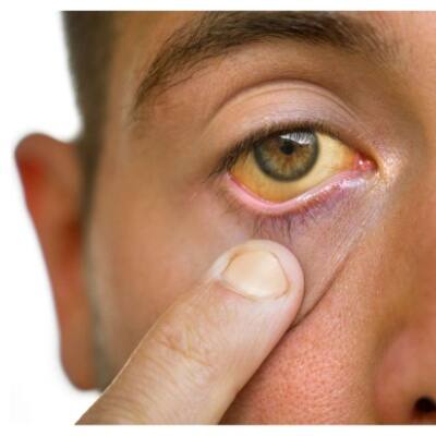Jaundice: కామెర్లు వస్తే ఏం తినాలో..? ఏం తినకూడదో తెలుసా?