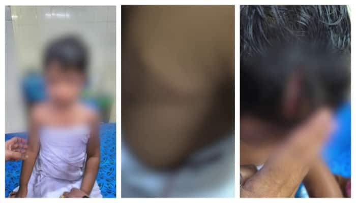 street dog attacked a 3 year old girl who was walking with her grandfather in Kollam Head and arm injuries