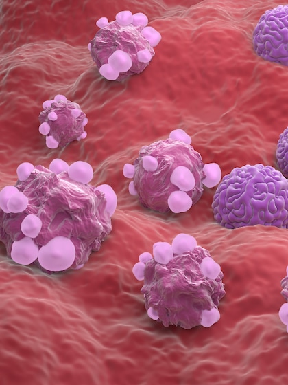 Cancer Causing Foods: ఇవి తింటే క్యాన్సర్ రావడం ఖాయం
