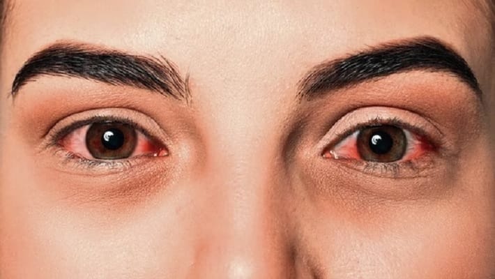 bleeding-eye-virus-marburg-virus-symptoms-causes-prevention