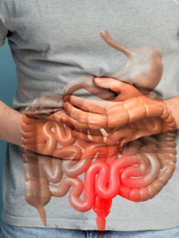 పెద్ద ప్రేగు క్యాన్సర్ (Colon Cancer)
