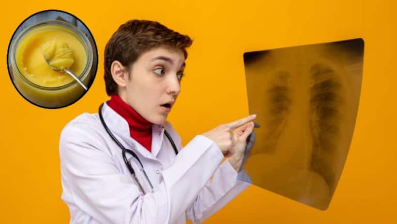 Deadly lipoid pneumonia due to ghee