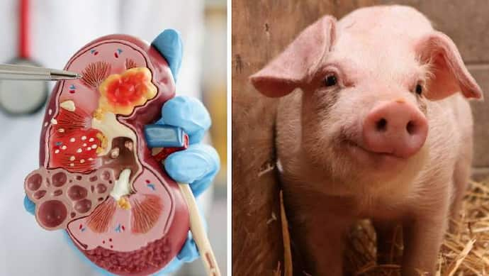 woman living healthy life with pig kidney