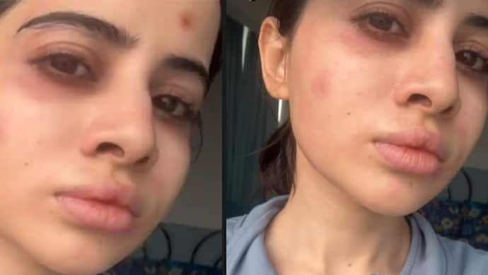 uorfi javed face gets rashes 