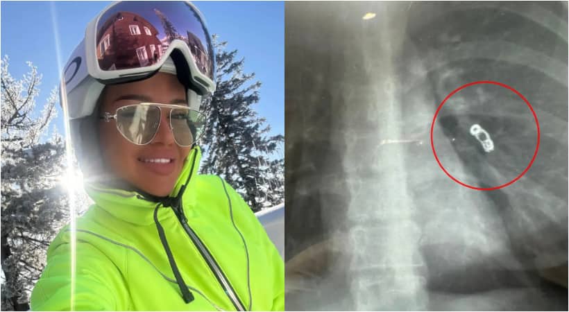 Russian Influencer thought she had a cold an X-ray revealed  surgical mishap