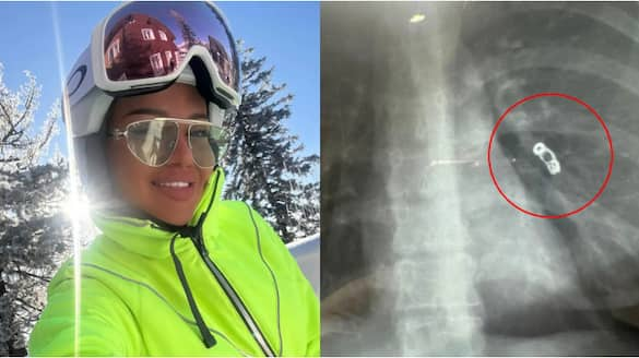 Russian Influencer thought she had a cold an X-ray revealed  surgical mishap