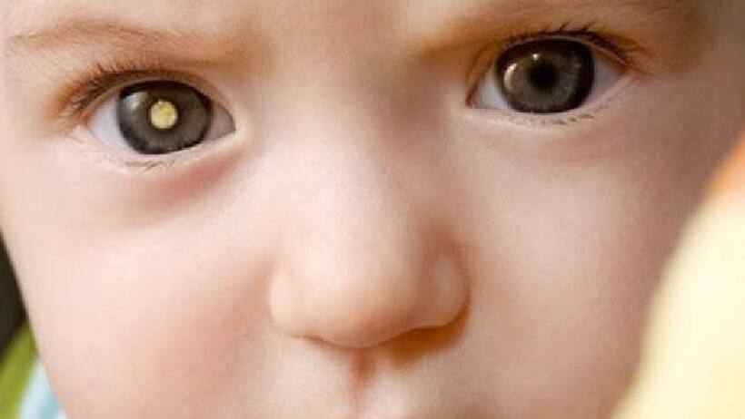 1 year girl loses eye due to rare cancer